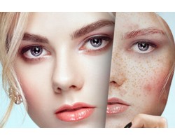Birth- sun- age spot creams